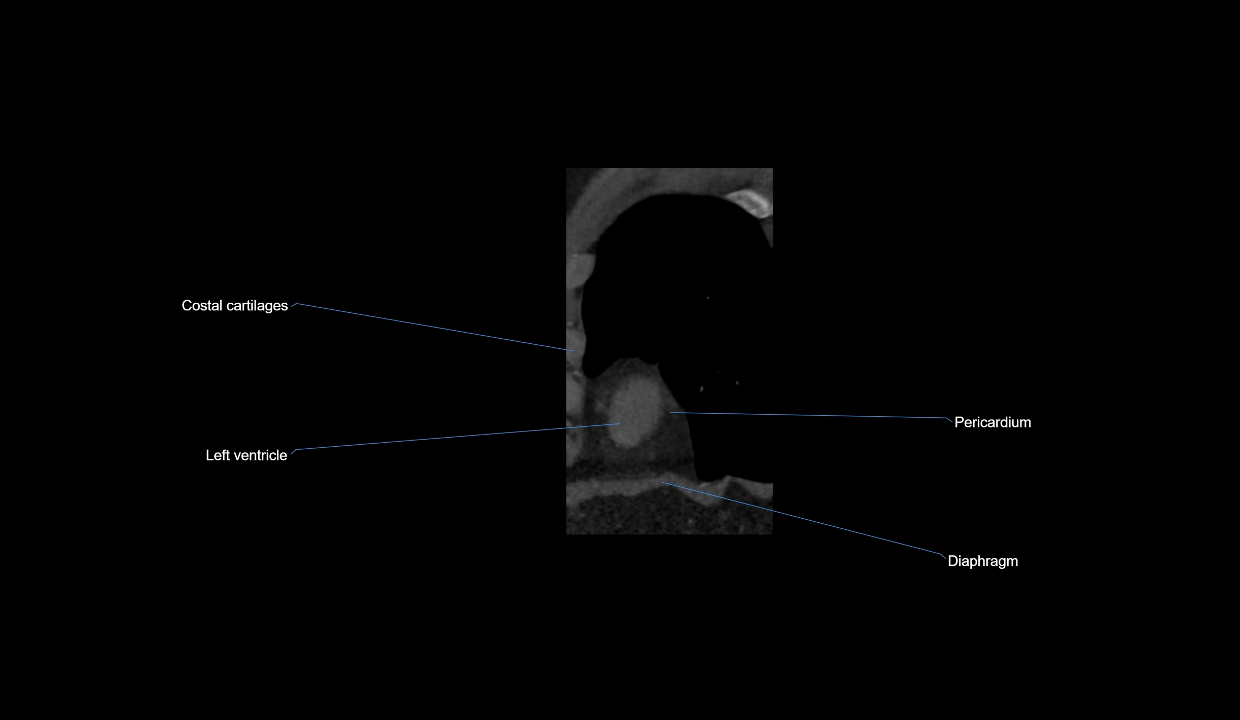CT heart (coronary angiogram) short axis view  cross sectional anatomy labelled radiology image-00049.webp